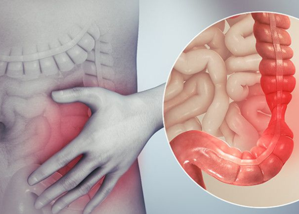 Hội chứng ruột kích thích (IBS), Tìm hiểu cùng chuyên gia! 