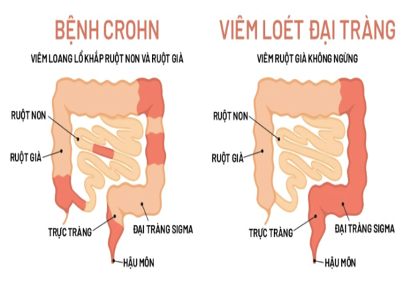 FTT_Phân biệt bệnh Crohn và hội chứng ruột kích thích (IBS)