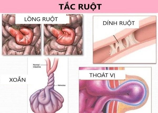 FTT_Tắc ruột là gì? Hiểu đúng để bảo vệ sức khỏe đường ruột