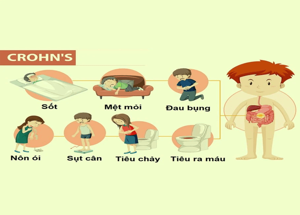 FTT_Phân biệt bệnh Crohn và hội chứng ruột kích thích (IBS)