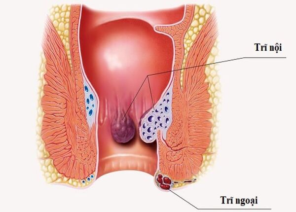 FTT_Tại sao viêm đại tràng lâu năm dễ mắc trĩ