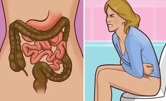 Ung thư đại tràng – Biến chứng nguy hiểm của viêm đại tràng 