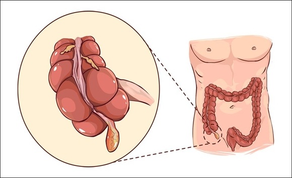 Phân biệt đau bụng thường và viêm ruột thừa: đừng chủ quan!
