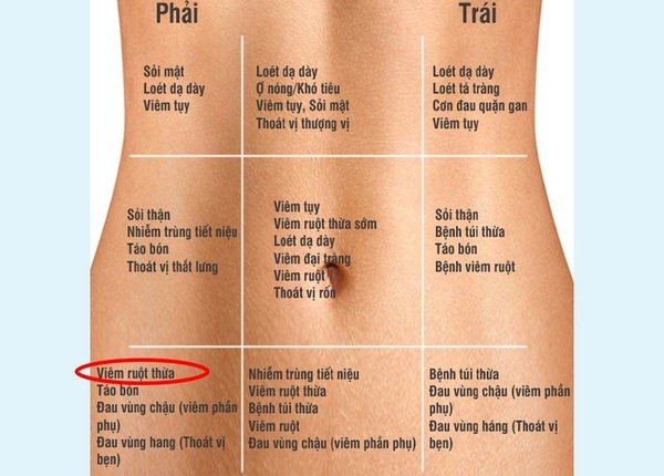 FTT_Phân biệt đau bụng thường và viêm ruột thừa