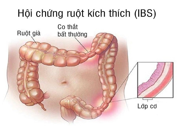 FTT_Hội chứng ruột kích thích có tự chữa khỏi tại nhà được không