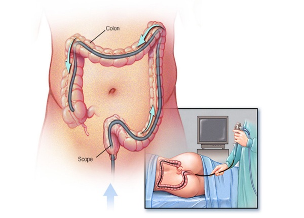 FTT_Nội soi đại tràng có đau không