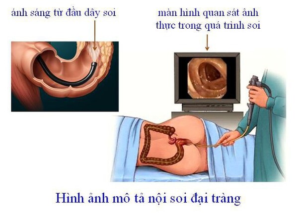 FTT_Viêm loét đại tràng, nguyên nhân, dấu hiệu và cách điều trị