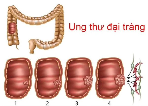 FTT_Ung thư đại tràng, biến chứng nguy hiểm của viêm đại tràng