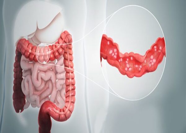 FTT_Viêm đại tràng, nguyên nhân, dấu hiệu và cách điều trị hiệu quả