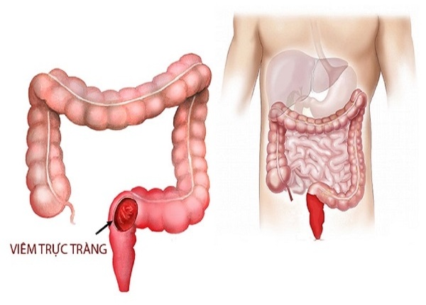 FTT_Viêm trực tràng và những dấu hiệu cơ thể đang phát tín hiệu