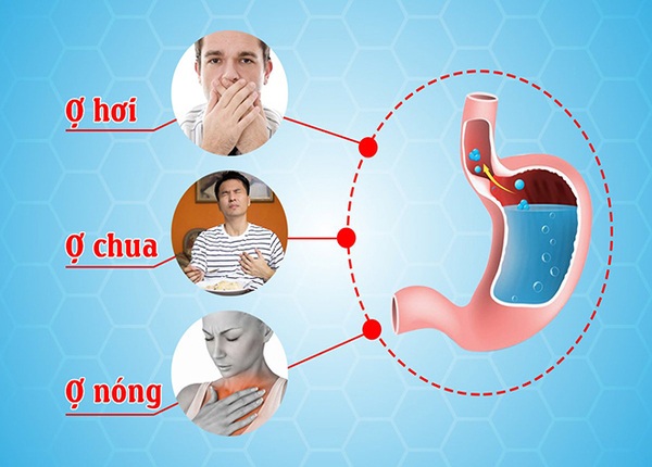 FTT_Chớ xem thường ợ chua, ợ hơi ở người trẻ