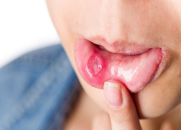 FTT_Nhiệt miệng do rối loạn tiêu hóa