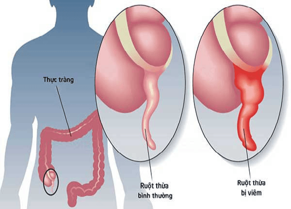 FTT_Viêm ruột thừa là gì?