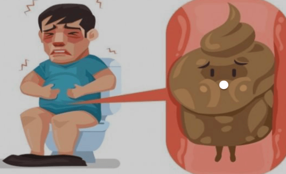 Đau bụng, táo bón kéo dài: Đừng bỏ qua nguy cơ hẹp đại tràng 