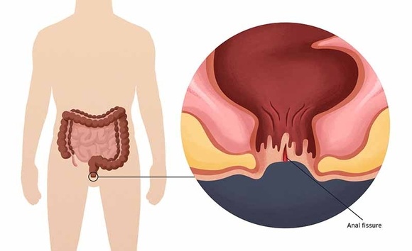 Rò hậu môn là gì? Làm sao nhận biết sớm để điều trị kịp thời? 