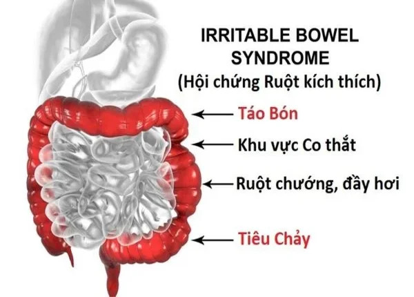 FTT_Ai có nguy cơ cao mắc hội chứng ruột kích thích