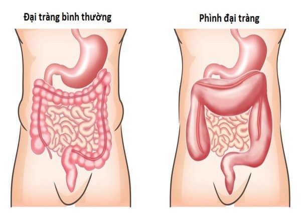 FTT_Phình đại tràng