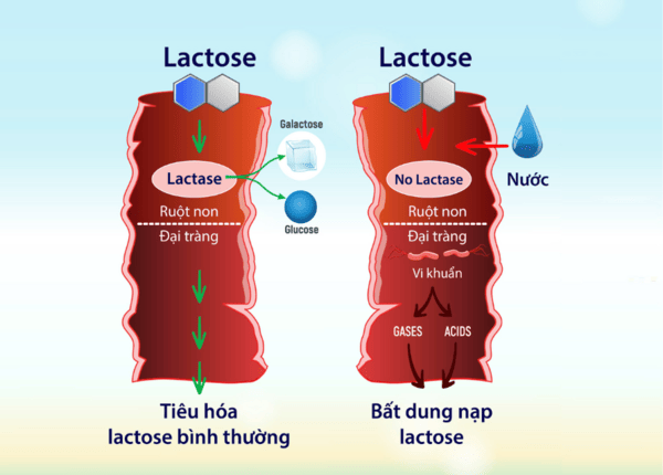 FTT_Không dung nạp lactose