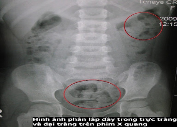 FTT_Hẹp đại tràng