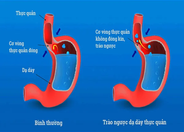 FTT_Trào ngược dạ dày thực quản là gì?