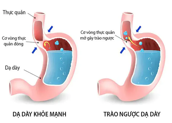 FTT_Ho do trào ngược dạ dày