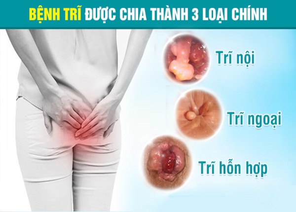 FTT_Phân biệt các loại trĩ