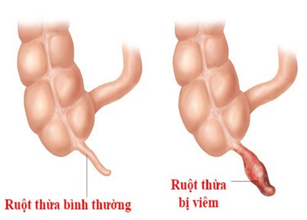 FTT_Phân biệt viêm ruột thừa với đau bụng thông thường