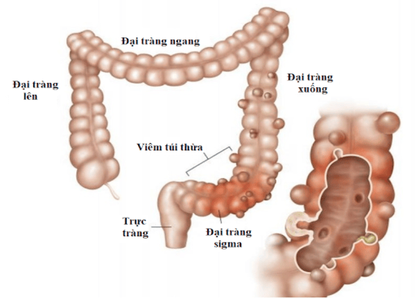 FTT_Viêm túi thừa đại tràng có nguy hiểm không?
