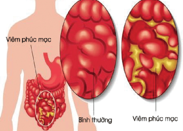FTT_Viêm phúc mạc là gì?
