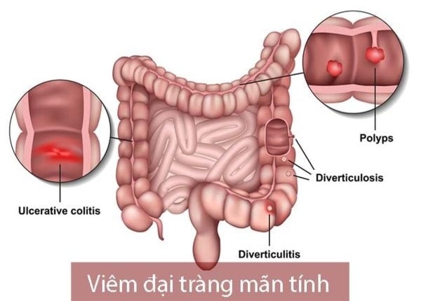 FTT_Viêm đại tràng mạn có thể dẫn đến suy nhược cơ thể không?