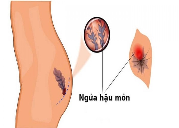 FTT_Ngứa hậu môn ban đêm