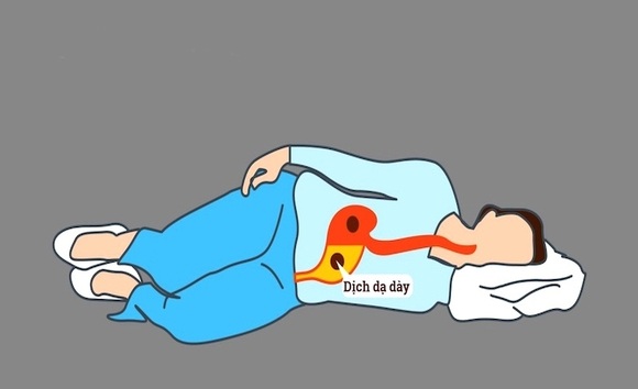 Tư thế nằm tốt cho người bệnh dạ dày – giảm trào ngược, dễ ngủ, bớt đau