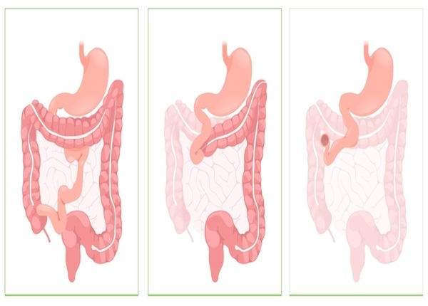 FTT_Hội chứng ruột ngắn