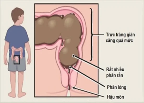 FTT_Thói quen nhịn vệ sinh lâu ngày