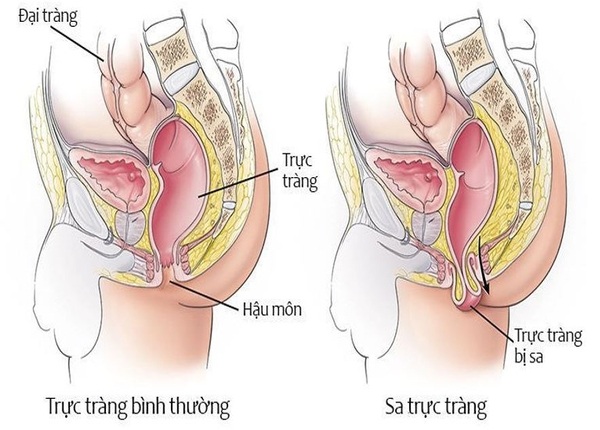 FTT_Sa trực tràng
