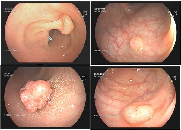 FTT_Tổng quan các loại polyp đại tràng