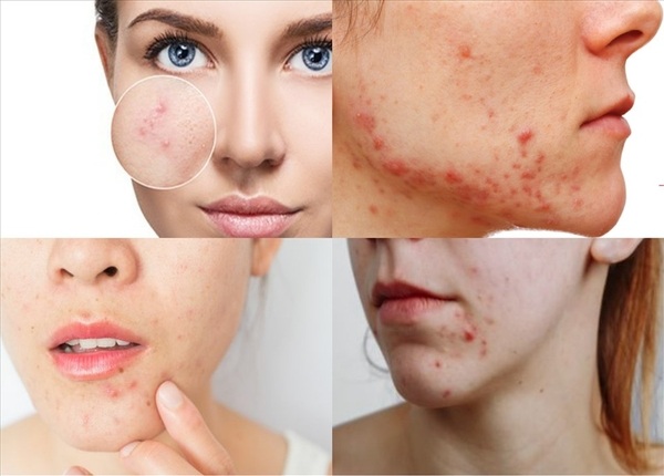 FTT_Mụn nội tiết do tiêu hóa – liệu có phải sự thật?
