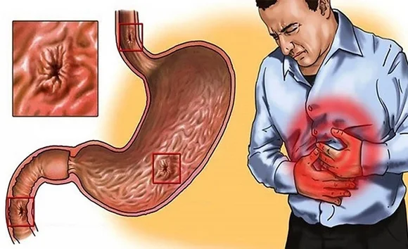 Gastritis là gì? Phân biệt viêm dạ dày cấp tính và mãn tính 