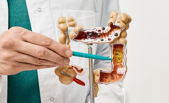 Niêm mạc đại tràng mỏng là gì? Nguy hiểm không và cách phục hồi tự nhiên 