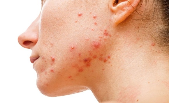 Mụn nội tiết do tiêu hóa – liệu có phải sự thật? 