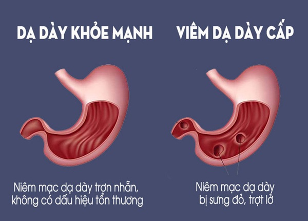 FTT_Gastritis là gì? Phân biệt viêm dạ dày cấp tính và mãn tính