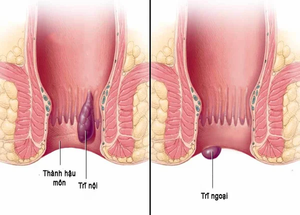FTT_Viêm đại tràng có dẫn đến trĩ không? 