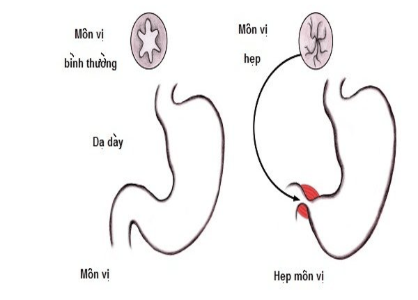 FTT_Hẹp môn vị là gì?