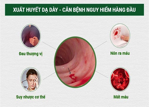 FTT_Xuất huyết dạ dày