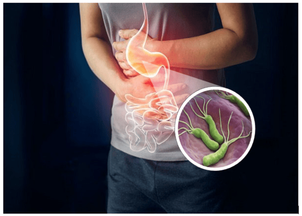 FTT_Nhiễm trùng dạ dày là gì? Nguyên nhân và cơ chế gây bệnh