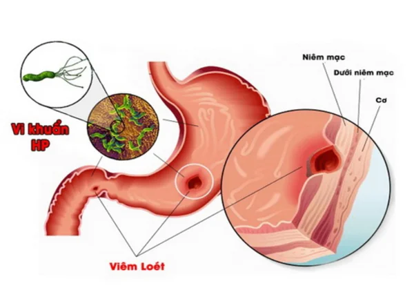 FTT_Loét niêm mạc dạ dày – Nguy hiểm thế nào nếu không điều trị sớm?