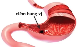 FTT_Viêm hang vị dạ dày có nguy hiểm không?