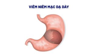 FTT_Loét niêm mạc dạ dày – Nguy hiểm thế nào nếu không điều trị sớm?