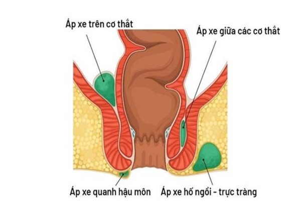 FTT_Phòng ngừa áp xe hậu môn: Những thói quen nhỏ mang lại lợi ích lớn