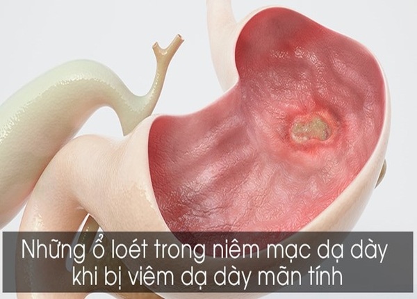 FTT_Niêm mạc dạ dày là gì?